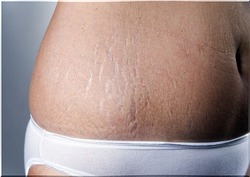 Woman with stretch marks - use vitamin E capsules