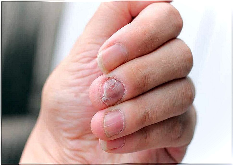 5 Natural Remedies To Treat Nail Psoriasis