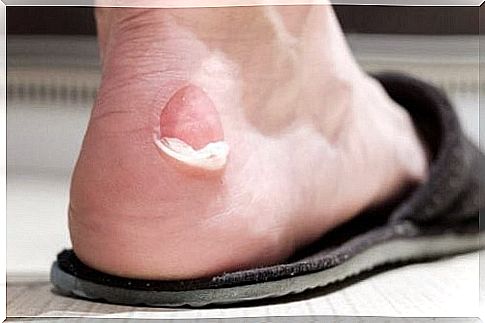 Blisters from shoes