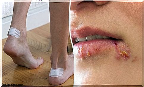 5 ways to cure and eliminate blisters