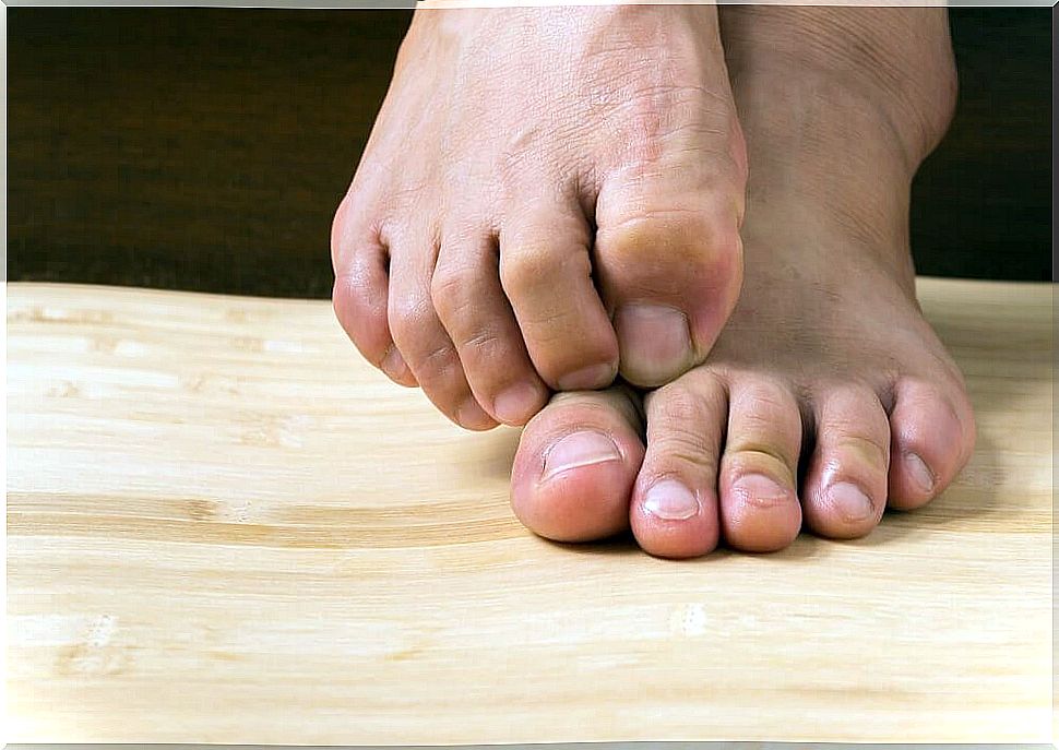 6 natural remedies for athlete's foot