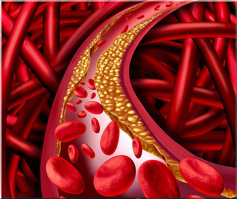 Elevated blood cholesterol