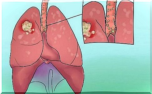 8 shocking signs of lung cancer you should not ignore