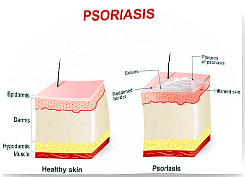 Psoriasis