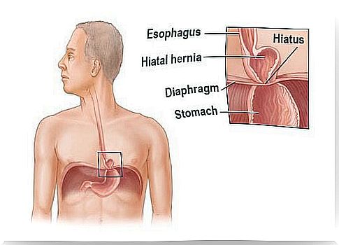 Can esophageal hernia be cured?  Learn these individual exercises