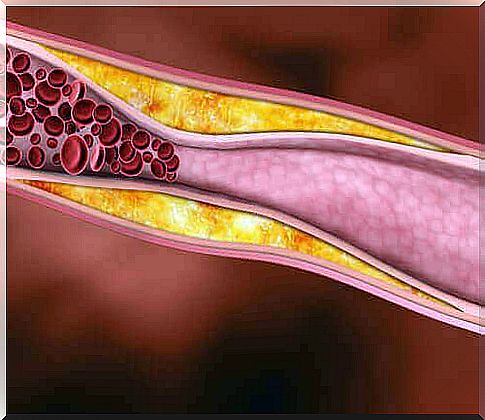 Narrowed blood vessels