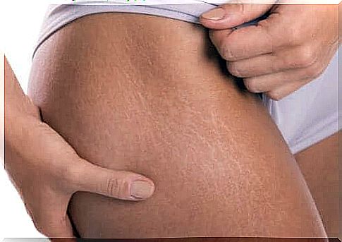 Make your own stretch mark cream with vitamin E.