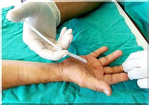 Injection of steroids in the treatment of spring finger