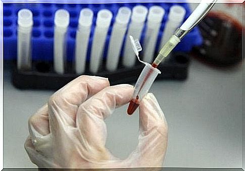 Stem cell transplantation could eradicate HIV