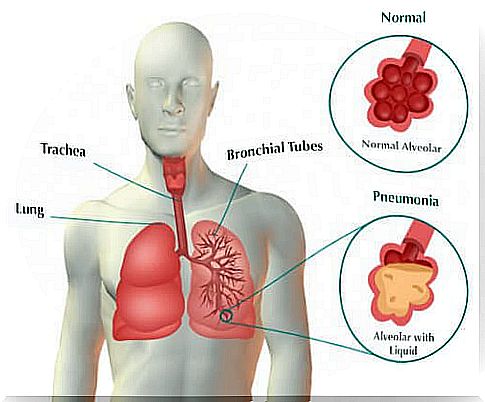 Symptoms of pneumonia and treatments