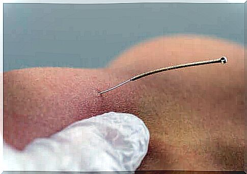 Treatment with dry needles - description and benefits