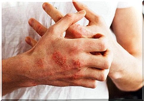 Person with psoriasis on hands scratches himself