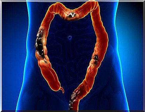 An image of an intestine with black spots.