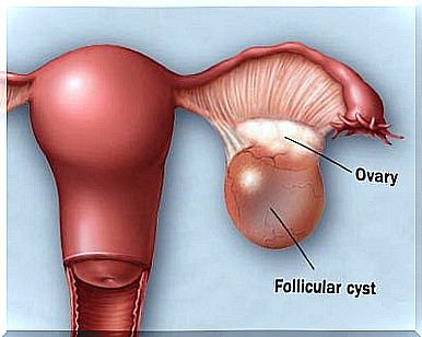 Abscess on the uterus