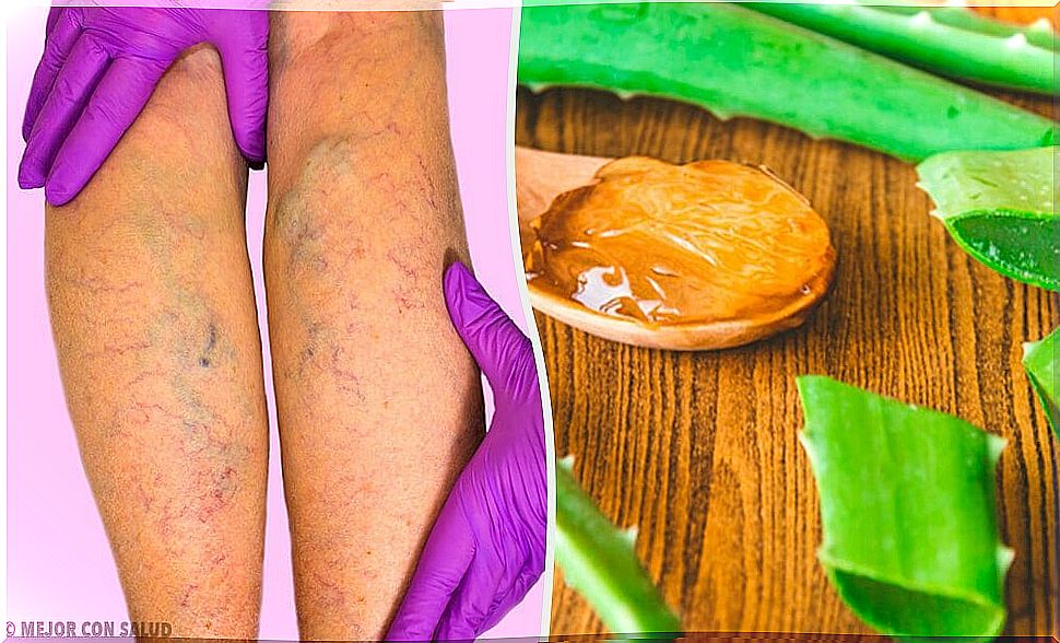 You can cure varicose veins with this aloe vera remedy