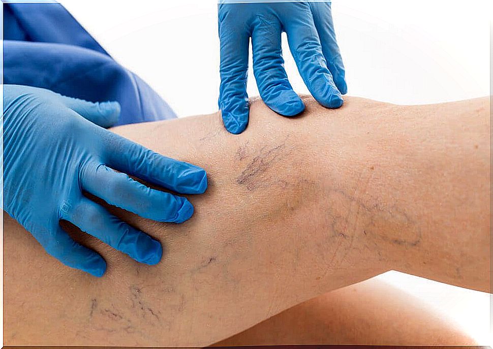 Person being examined for varicose veins