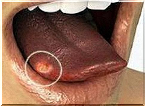 tongue-ulcer